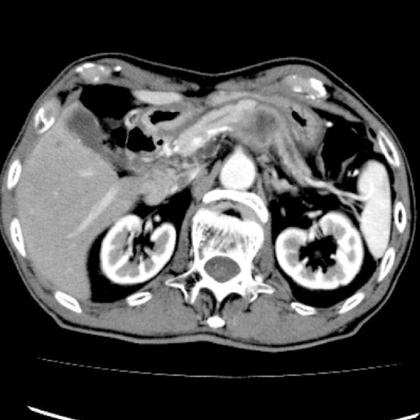 膵体部癌のCT画像